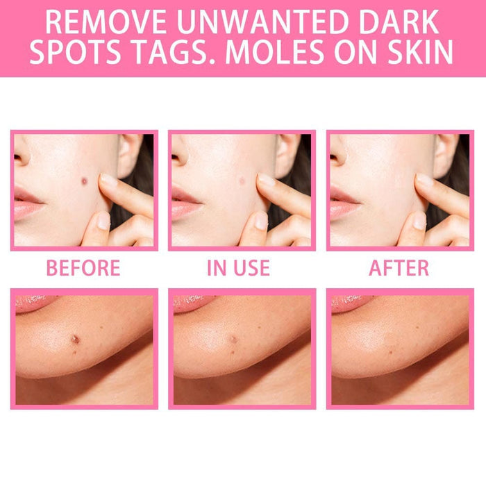 Facial mole removal cream, repairing and repairing essential oil, repairing and removing moles, preventing scars
