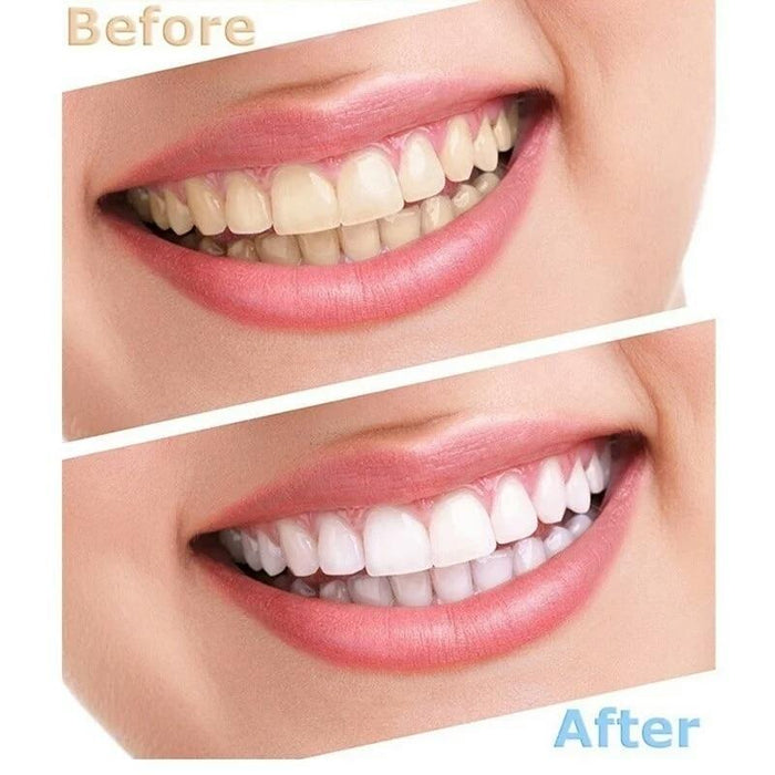 Top Quality Peroxide Teeth Whitening Kit Bleaching System Bright White Smile Teeth Whitening Gel Kit With LED Light Professional